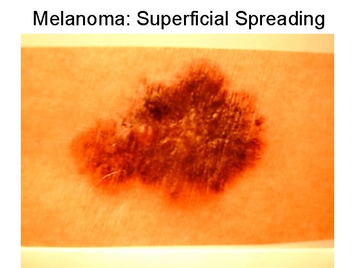 Melanoma: Superficial Spreading 