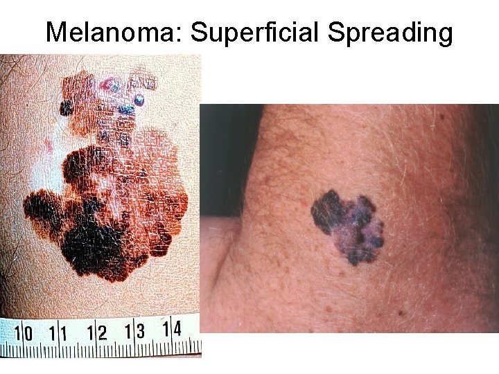 Melanoma: Superficial Spreading 