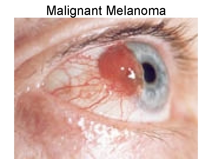 Malignant Melanoma 