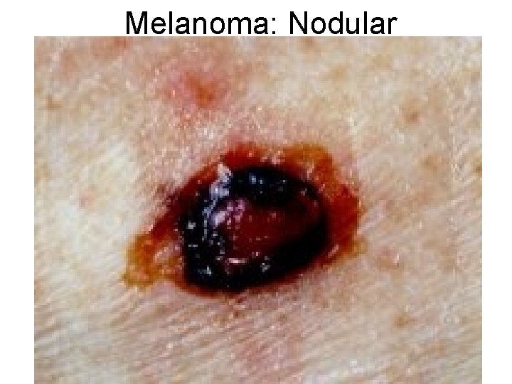 Melanoma: Nodular 