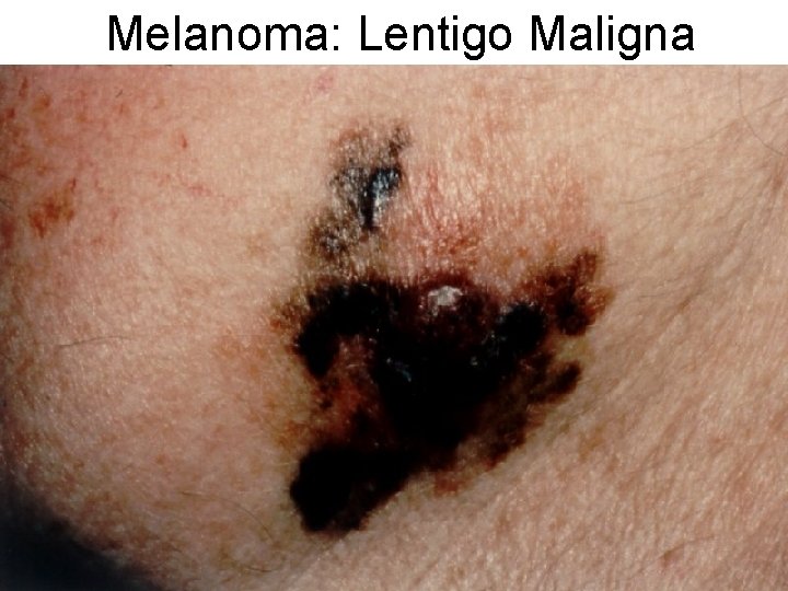Melanoma: Lentigo Maligna 
