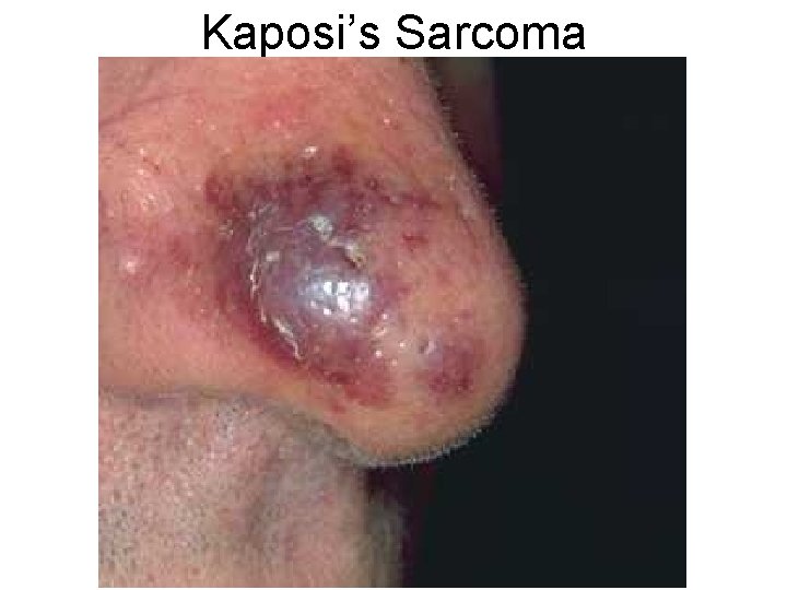 Kaposi’s Sarcoma 