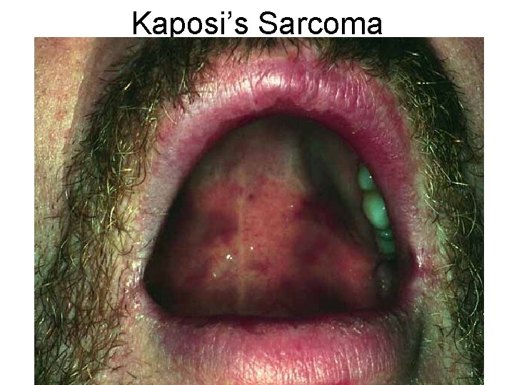 Kaposi’s Sarcoma 