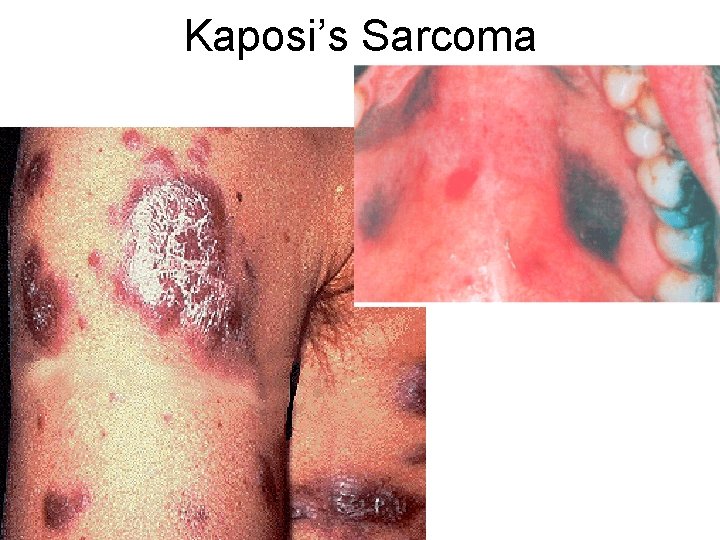Kaposi’s Sarcoma 