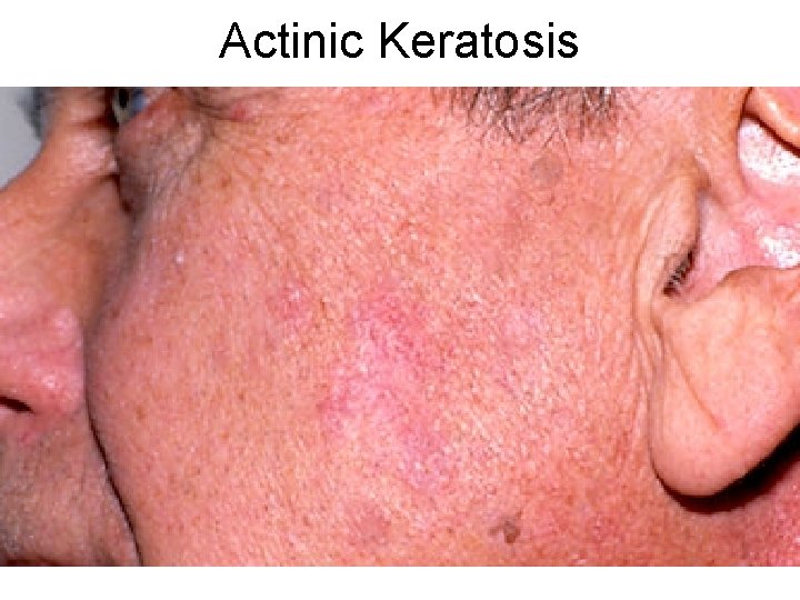 Actinic Keratosis 
