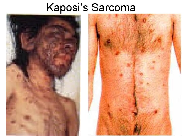 Kaposi’s Sarcoma 