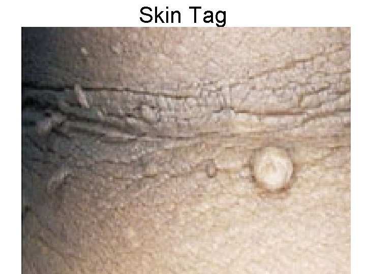 Skin Tag 
