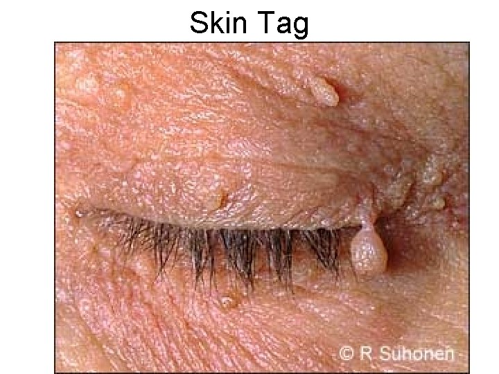 Skin Tag 