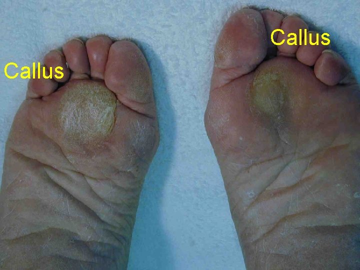 Callus 
