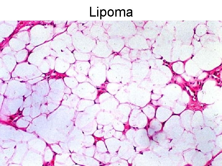 Lipoma 