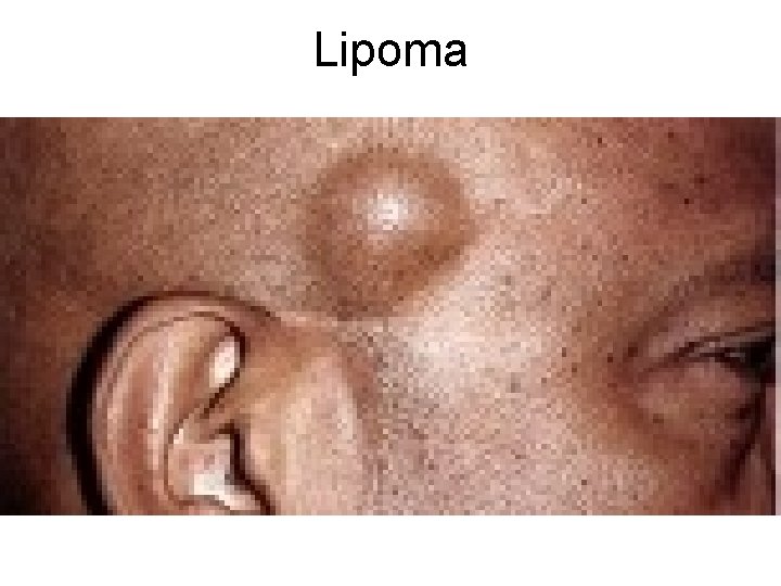 Lipoma 