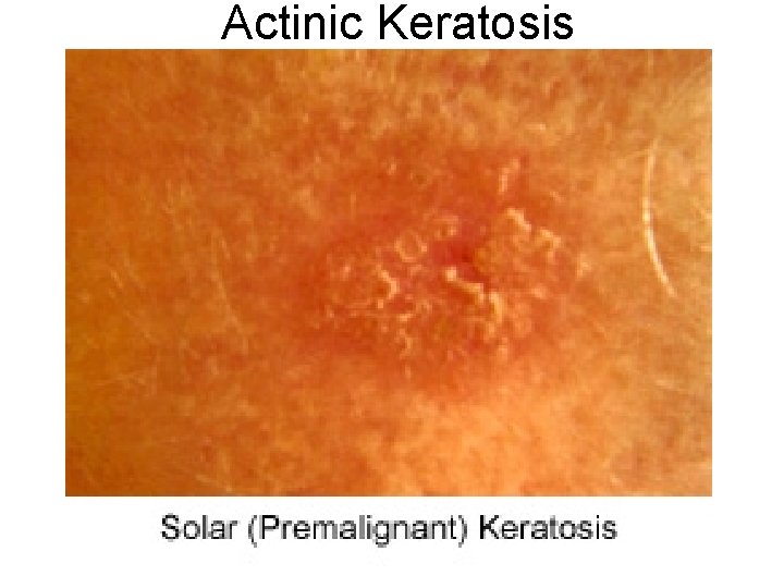 Actinic Keratosis 