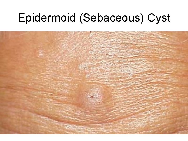 Epidermoid (Sebaceous) Cyst 