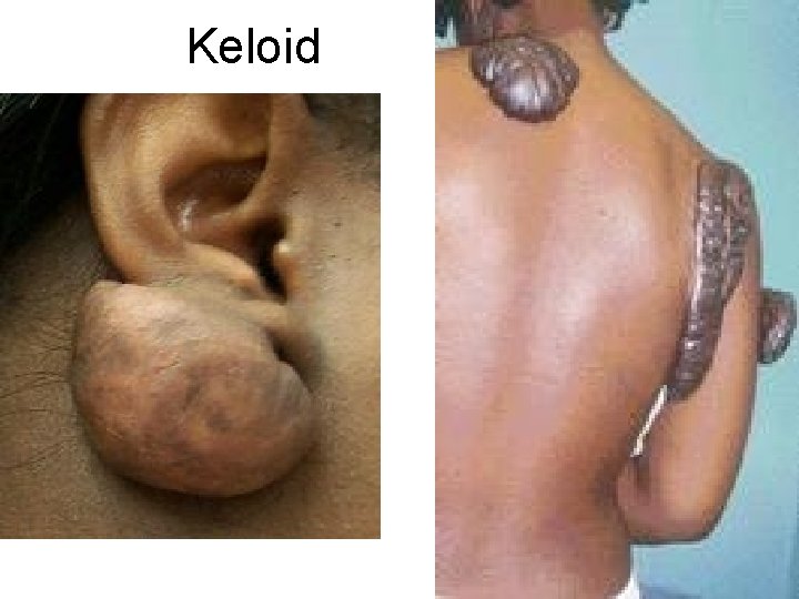 Keloid 