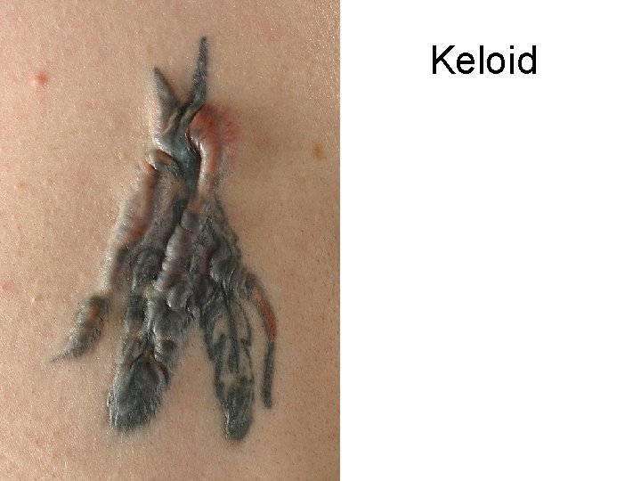Keloid 