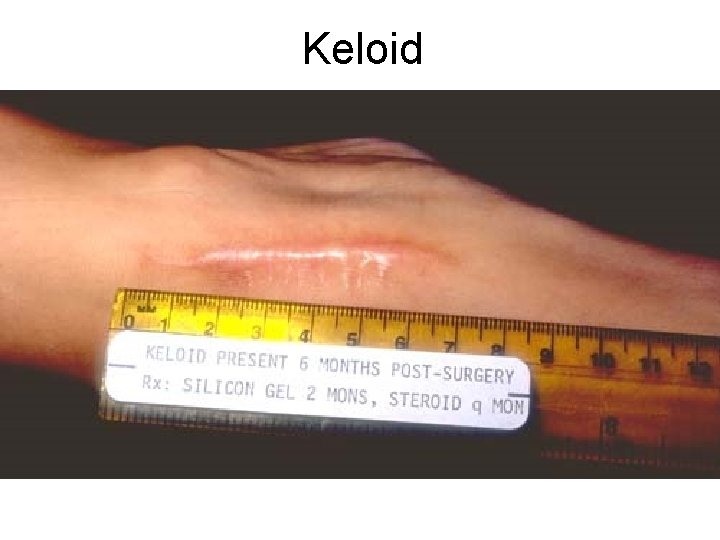 Keloid 