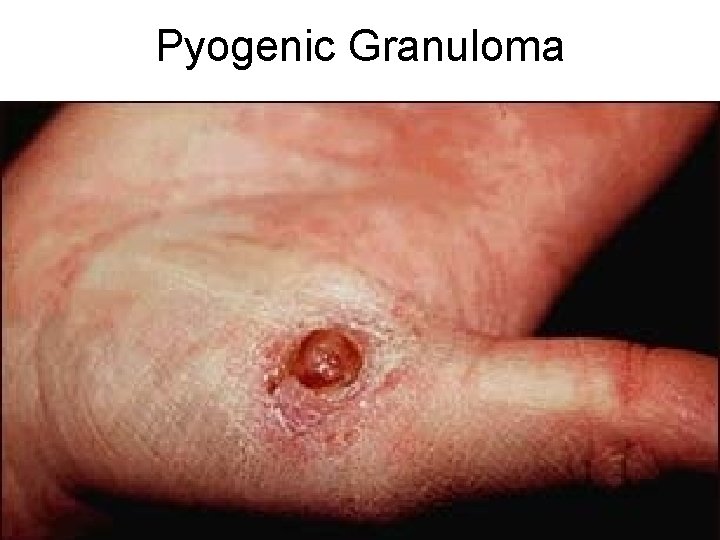 Pyogenic Granuloma 