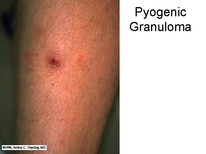 Pyogenic Granuloma 