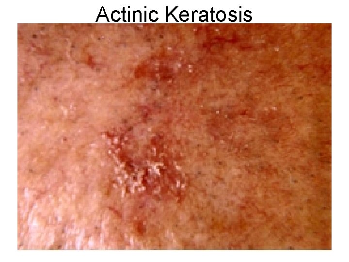 Actinic Keratosis 