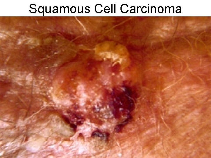 Squamous Cell Carcinoma 