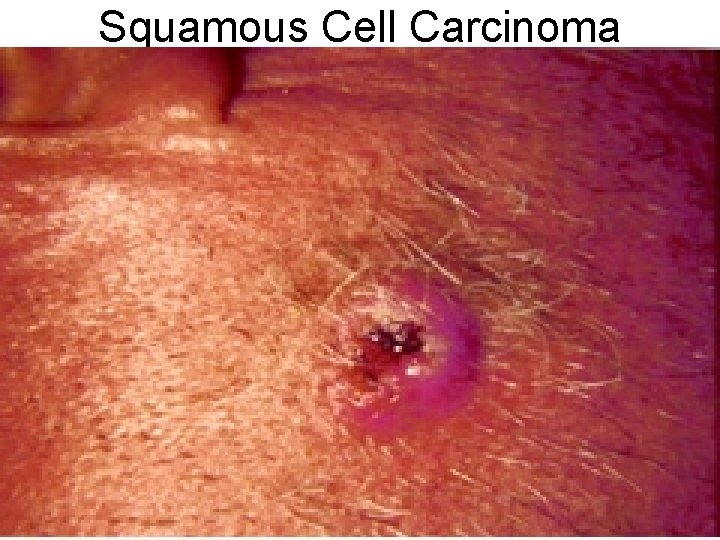 Squamous Cell Carcinoma 