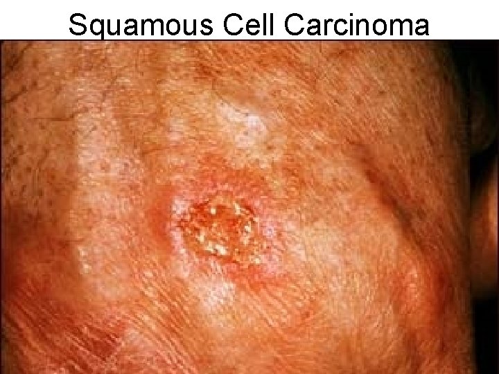 Squamous Cell Carcinoma 
