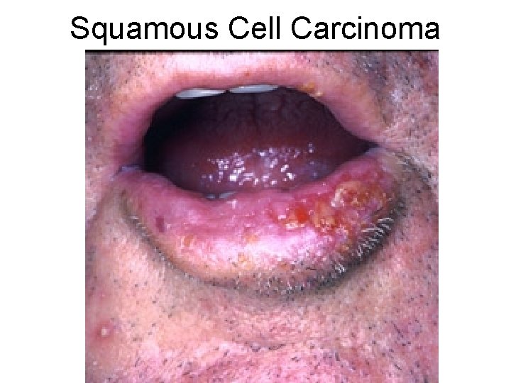 Squamous Cell Carcinoma 
