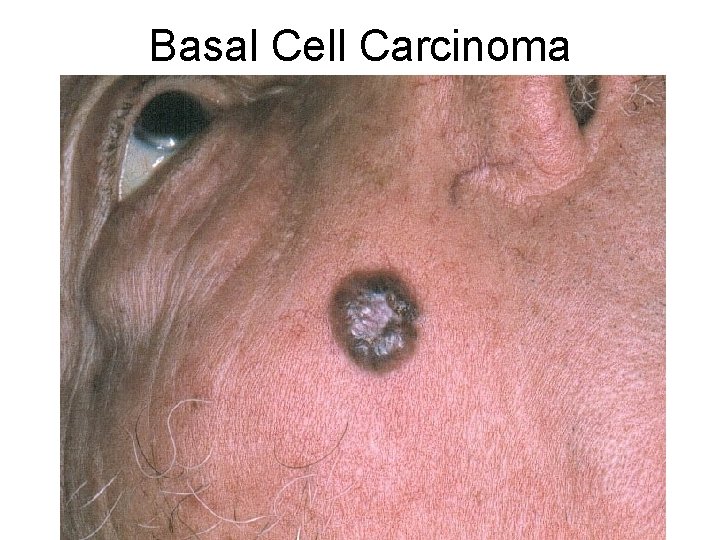 Basal Cell Carcinoma 
