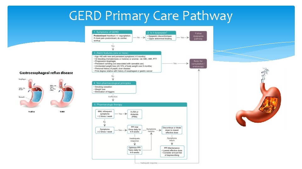 GERD Primary Care Pathway 