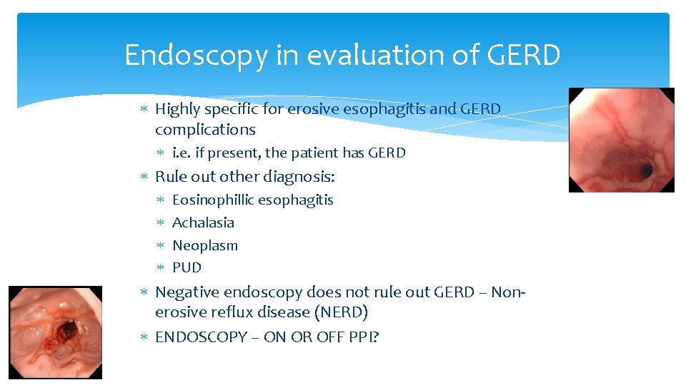 Endoscopy in evaluation of GERD Highly specific for erosive esophagitis and GERD complications i.