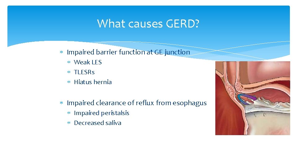 What causes GERD? Impaired barrier function at GE junction Weak LES TLESRs Hiatus hernia