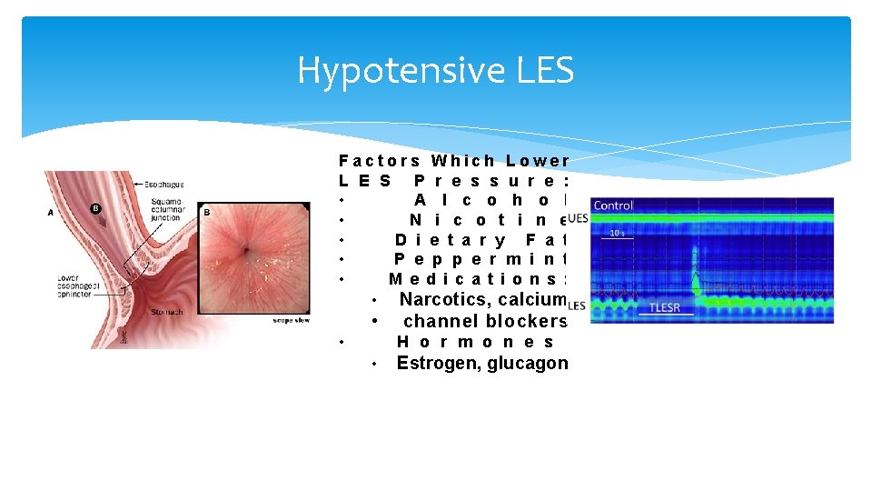 Hypotensive LES Factors Which Lower L E S P r e s s u