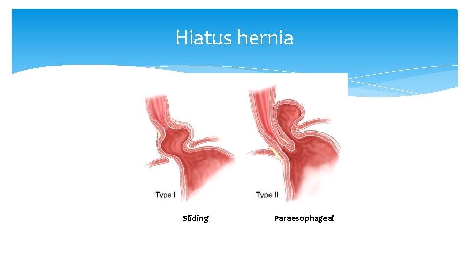 Hiatus hernia Sliding Paraesophageal 