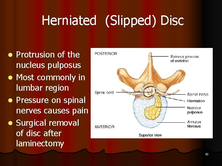 Herniated (Slipped) Disc l l Protrusion of the nucleus pulposus Most commonly in lumbar