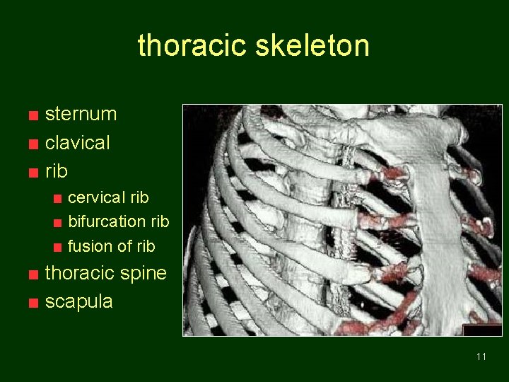 thoracic skeleton sternum clavical rib cervical rib bifurcation rib fusion of rib thoracic spine