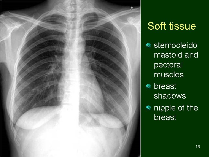 Soft tissue stemocleido mastoid and pectoral muscles breast shadows nipple of the breast 16