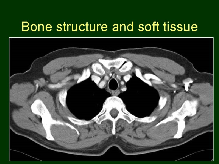 Bone structure and soft tissue 19 