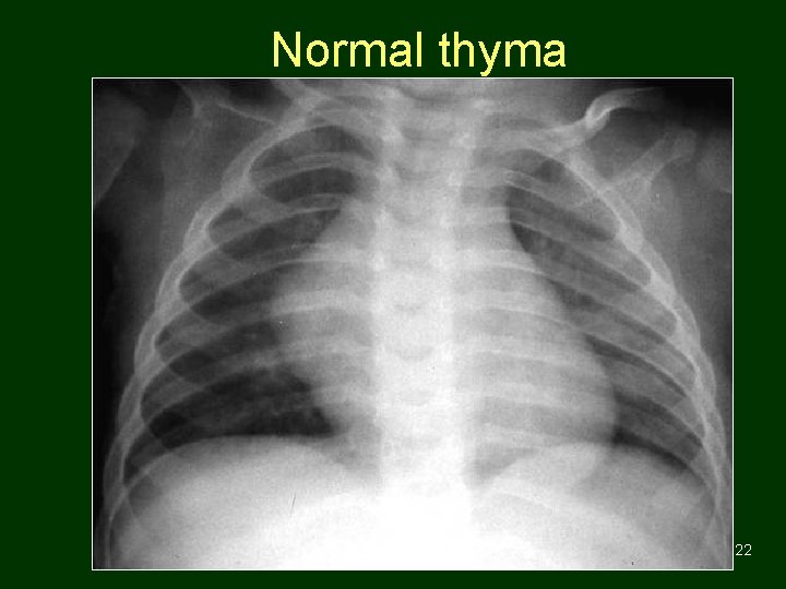Normal thyma 22 