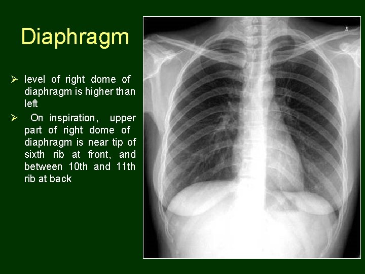 Diaphragm Ø level of right dome of diaphragm is higher than left Ø On