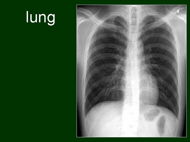 lung 48 