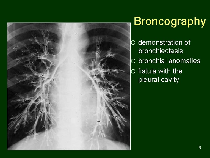 Broncography ¡ demonstration of bronchiectasis ¡ bronchial anomalies ¡ fistula with the pleural cavity