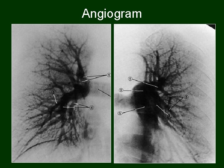 Angiogram 63 