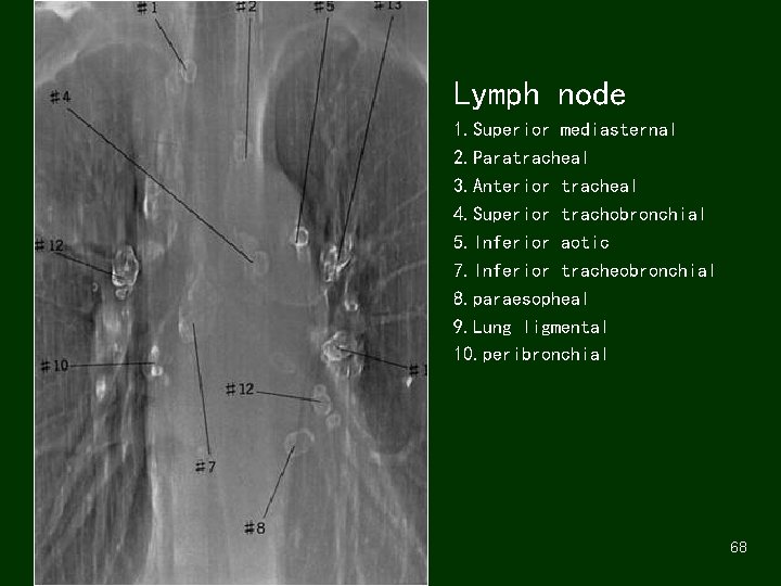 Lymph node 1. Superior mediasternal 2. Paratracheal 3. Anterior tracheal 4. Superior trachobronchial 5.