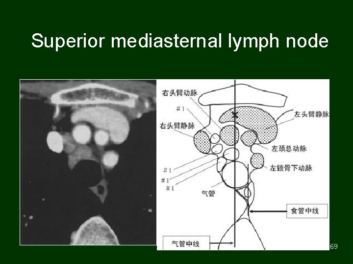 Superior mediasternal lymph node 69 