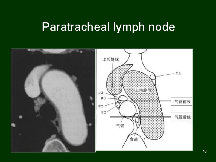 Paratracheal lymph node 70 