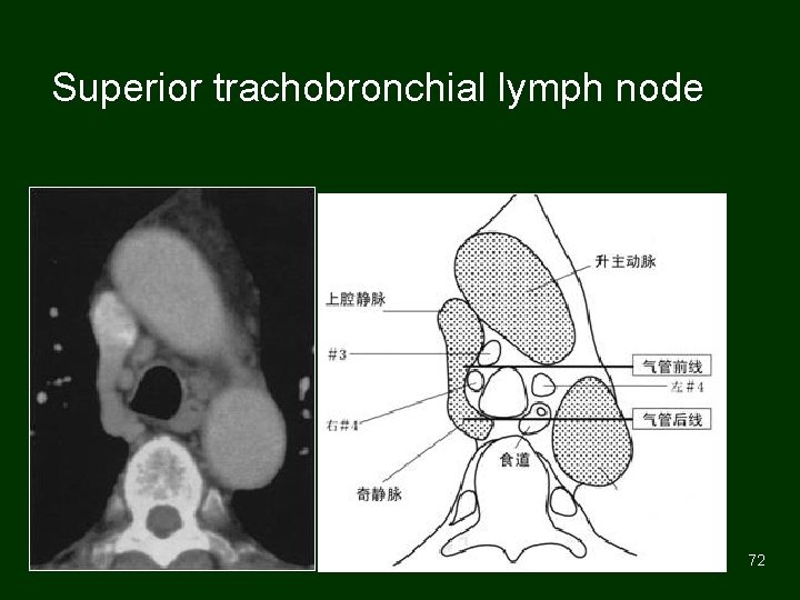Superior trachobronchial lymph node 72 