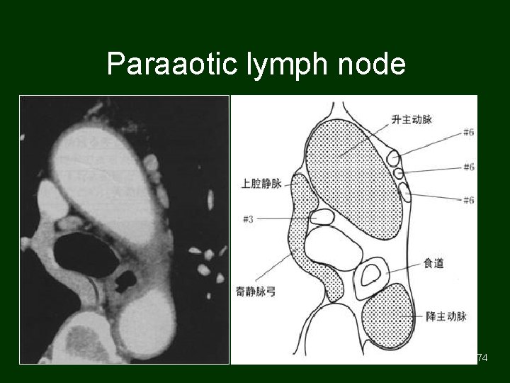 Paraaotic lymph node 74 