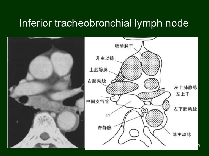 Inferior tracheobronchial lymph node 75 