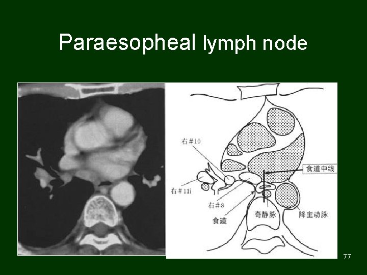Paraesopheal lymph node 77 