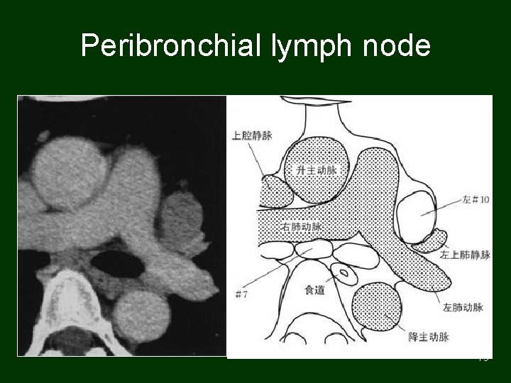 Peribronchial lymph node 79 